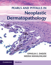 Pearls and Pitfalls in Neoplastic Dermatopathology